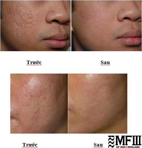 hiệu quả sau điều trị sẹo lõm, sẹo rỗ